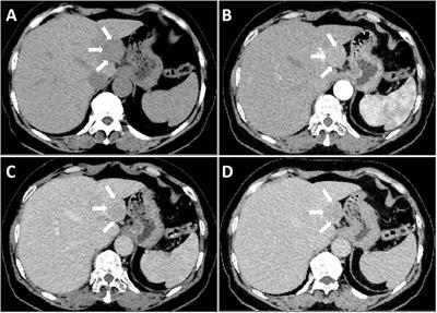 Case report: Uncommon manifestations of Rosai-Dorfman disease in the liver mimicking HCC